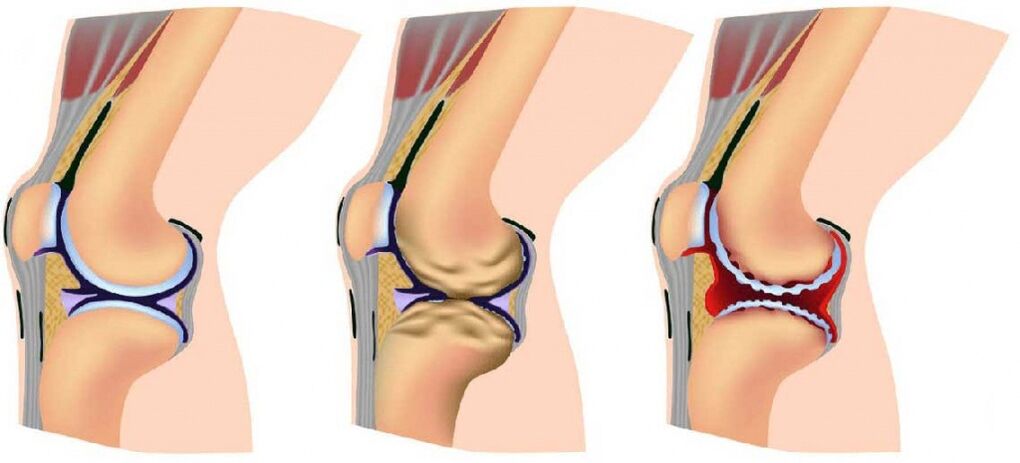 Gesundes Gelenk und durch Arthrose betroffen