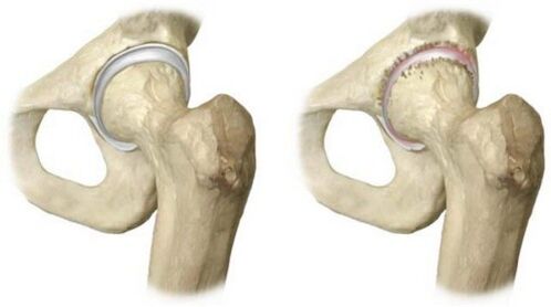 gesundes und von Arthrose betroffenes Hüftgelenk